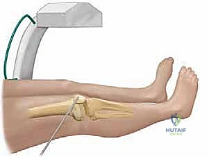 صورة توضيحية للأعراض السريرية واعوجاج الأطراف
