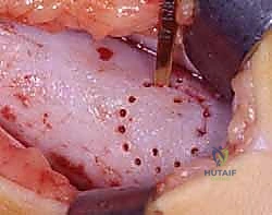 دواعي إجراء الجراحة وتقييم حجم العائق