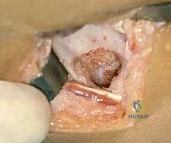 الخطوة الجراحية الأولى: التخطيط وعمل النافذة العظمية