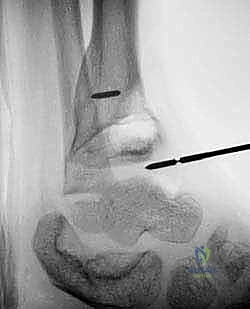 الأشعة السينية تظهر العائق العظمي وتوقف النمو