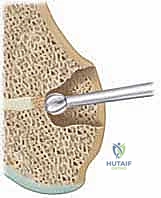 صورة توضيحية لأسباب تكوين العائق العظمي مثل الكسور