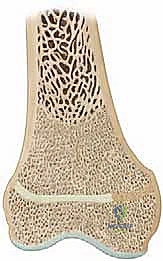 القص العظمي التصحيحي المصاحب لاستئصال العائق