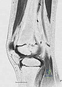 صورة توضيحية لـ إزالة العائق العظمي من صفيحة النمو: استعادة النمو الطبيعي وتصحيح التشوهات للأطفال
