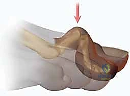 إصبع القدم المطرقية دليل شامل للعلاج والتعافي مع الأستاذ الدكتور محمد هطيف في صنعاء