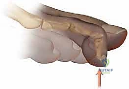 صورة توضيحية لـ إصبع القدم المطرقية دليل شامل للعلاج والتعافي مع الأستاذ الدكتور محمد هطيف في صنعاء