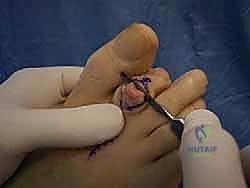 صورة توضيحية لـ إصبع القدم المطرقية دليل شامل للعلاج والتعافي مع الأستاذ الدكتور محمد هطيف في صنعاء