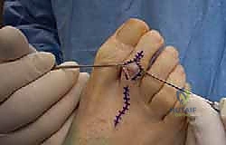 صورة توضيحية لـ إصبع القدم المطرقية دليل شامل للعلاج والتعافي مع الأستاذ الدكتور محمد هطيف في صنعاء