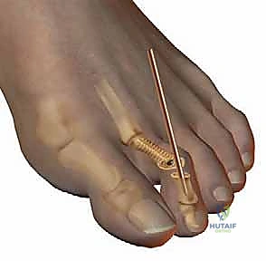 صورة طبية: إصبع القدم المطرقية دليل شامل للعلاج والتعافي مع الأستاذ الدكتور محمد هطيف في صنعاء