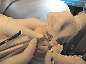 صورة طبية: إصبع القدم المطرقية دليل شامل للعلاج والتعافي مع الأستاذ الدكتور محمد هطيف في صنعاء