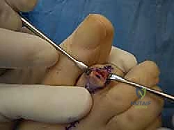 صورة طبية: إصبع القدم المطرقية دليل شامل للعلاج والتعافي مع الأستاذ الدكتور محمد هطيف في صنعاء