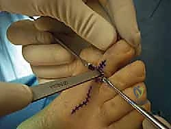 توضيح لعملية تحرير الأوتار وإطالتها في جراحات الأنسجة الرخوة