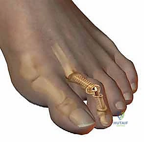 صورة توضيحية لـ إصبع القدم المطرقية دليل شامل للعلاج والتعافي مع الأستاذ الدكتور محمد هطيف في صنعاء