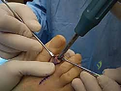 صورة توضيحية لـ إصبع القدم المطرقية دليل شامل للعلاج والتعافي مع الأستاذ الدكتور محمد هطيف في صنعاء