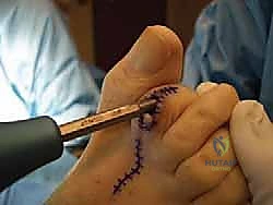 صورة طبية: إصبع القدم المطرقية دليل شامل للعلاج والتعافي مع الأستاذ الدكتور محمد هطيف في صنعاء