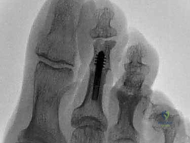 صورة أشعة سينية توضح تشوه إصبع القدم المطرقية وتأثيره على العظام