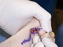 توضيح لعملية تثبيت المفصل Arthrodesis باستخدام الغرسات الحديثة