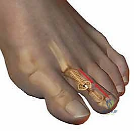 Masterclass in Hammer Toe Correction: PIP Arthroplasty & Arthrodesis Techniques