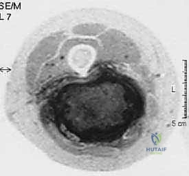 الفحص السريري لتورم الفخذ الخلفي