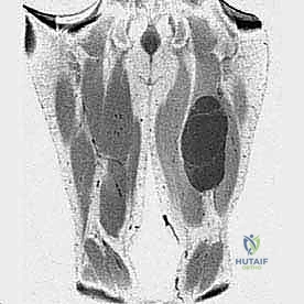 مسار العصب الوركي في الفخذ الخلفي