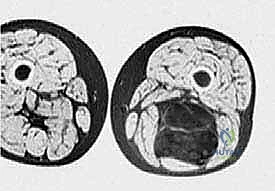 التشريح الدقيق لعضلات الفخذ الخلفية وعلاقتها بالأورام