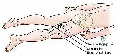 صورة رنين مغناطيسي توضح امتداد ساركوما الفخذ