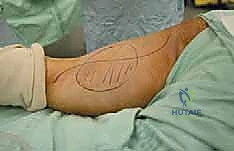 أخذ خزعة دقيقة من ورم الفخذ تحت إشراف الأشعة