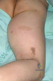 شكل الخلايا السرطانية في ساركوما الأنسجة الرخوة