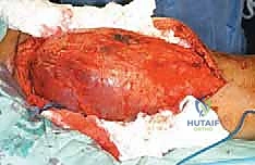 صورة طبية: استئصال ساركوما الفخذ الخلفية: دليل شامل لمرضى الأستاذ الدكتور محمد هطيف في صنعاء