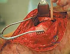 صورة طبية: استئصال ساركوما الفخذ الخلفية: دليل شامل لمرضى الأستاذ الدكتور محمد هطيف في صنعاء