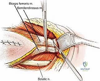 استئصال ساركوما الفخذ الخلفية: دليل شامل لمرضى الأستاذ الدكتور محمد هطيف في صنعاء