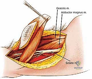 صورة توضيحية لـ استئصال ساركوما الفخذ الخلفية: دليل شامل لمرضى الأستاذ الدكتور محمد هطيف في صنعاء