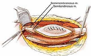 صورة توضيحية لـ استئصال ساركوما الفخذ الخلفية: دليل شامل لمرضى الأستاذ الدكتور محمد هطيف في صنعاء