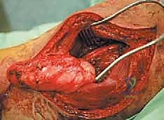 صورة توضيحية لـ استئصال ساركوما الفخذ الخلفية: دليل شامل لمرضى الأستاذ الدكتور محمد هطيف في صنعاء