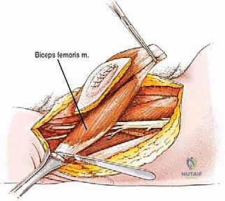 صورة توضيحية لـ استئصال ساركوما الفخذ الخلفية: دليل شامل لمرضى الأستاذ الدكتور محمد هطيف في صنعاء