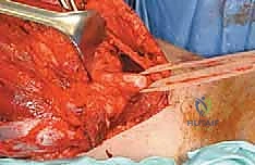 صورة توضيحية لـ استئصال ساركوما الفخذ الخلفية: دليل شامل لمرضى الأستاذ الدكتور محمد هطيف في صنعاء