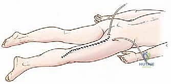 صورة توضيحية لـ استئصال ساركوما الفخذ الخلفية: دليل شامل لمرضى الأستاذ الدكتور محمد هطيف في صنعاء