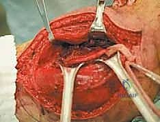 صورة طبية: استئصال ساركوما الفخذ الخلفية: دليل شامل لمرضى الأستاذ الدكتور محمد هطيف في صنعاء