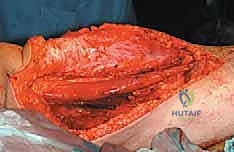 صورة طبية: استئصال ساركوما الفخذ الخلفية: دليل شامل لمرضى الأستاذ الدكتور محمد هطيف في صنعاء