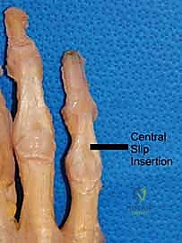 كسور السلاميات خارج المفصل دليل شامل للعلاج مع الأستاذ الدكتور محمد هطيف في صنعاء