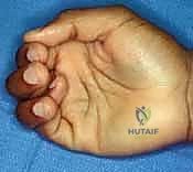 صورة توضح الأوتار القابضة ونظام البكرات المعقد في الأصابع