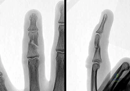 صورة سريرية توضح ظاهرة تداخل الأصابع أو التشوه الدوراني الناجم عن كسر في السلامية