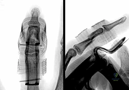 صورة شعاعية توضح كسراً حاداً في السلامية القريبة ناتج عن إصابة رياضية