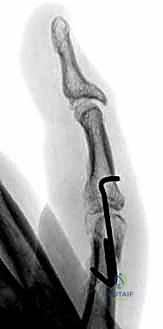 صورة توضح التثبيت باستخدام البراغي الساحبة لكسر مائل طويل