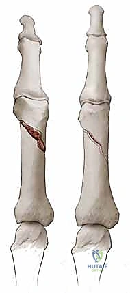 صورة توضيحية لـ كسور السلاميات خارج المفصل دليل شامل للعلاج مع الأستاذ الدكتور محمد هطيف في صنعاء