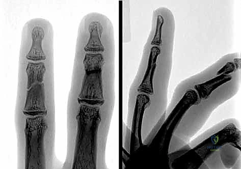 صورة طبية: كسور السلاميات خارج المفصل دليل شامل للعلاج مع الأستاذ الدكتور محمد هطيف في صنعاء