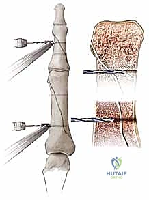 صورة شعاعية تظهر الحاجة الماسة للتدخل الجراحي بسبب الانزياح الشديد للعظم