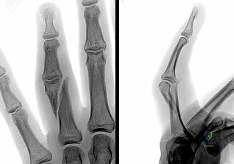 صورة توضيحية لـ كسور السلاميات خارج المفصل دليل شامل للعلاج مع الأستاذ الدكتور محمد هطيف في صنعاء