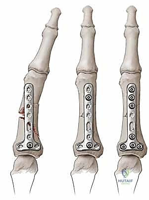 صورة توضيحية لـ كسور السلاميات خارج المفصل دليل شامل للعلاج مع الأستاذ الدكتور محمد هطيف في صنعاء