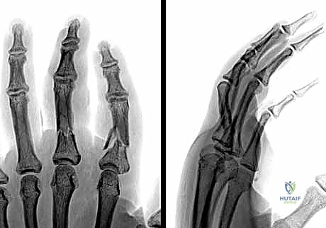 صورة شعاعية توضح استخدام أسلاك كيرشنر الدقيقة لتثبيت كسر في السلامية