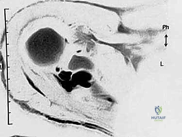نقاط الانضغاط في الشق فوق الكتفي والشق الشوكي الحقاني